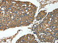 The image on the left is immunohistochemistry of paraffin-embedded Human breast cancer tissue using CSB-PA187078(MSN Antibody) at dilution 1/30, on the right is treated with fusion protein. (Original magnification: ×200)