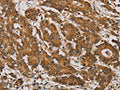 The image on the left is immunohistochemistry of paraffin-embedded Human colon cancer tissue using CSB-PA187096(NDUFA10 Antibody) at dilution 1/40, on the right is treated with fusion protein. (Original magnification: ×200)