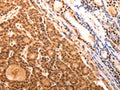 The image on the left is immunohistochemistry of paraffin-embedded Human thyroid cancer tissue using CSB-PA187673(SERPINC1 Antibody) at dilution 1/15, on the right is treated with fusion protein. (Original magnification: ×200)