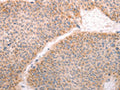 The image on the left is immunohistochemistry of paraffin-embedded Human thyroid cancer tissue using CSB-PA187767(ABHD12 Antibody) at dilution 1/30, on the right is treated with fusion protein. (Original magnification: ×200)