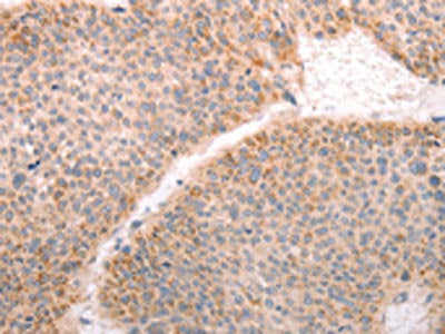 The image on the left is immunohistochemistry of paraffin-embedded Human thyroid cancer tissue using CSB-PA187767(ABHD12 Antibody) at dilution 1/30, on the right is treated with fusion protein. (Original magnification: ×200)