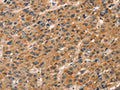 The image on the left is immunohistochemistry of paraffin-embedded Human liver cancer tissue using CSB-PA188638(CXCR6 Antibody) at dilution 1/20, on the right is treated with fusion protein. (Original magnification: ×200)