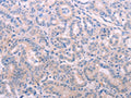The image on the left is immunohistochemistry of paraffin-embedded Human thyroid cancer tissue using CSB-PA188746(TIMP4 Antibody) at dilution 1/15, on the right is treated with fusion protein. (Original magnification: ×200)