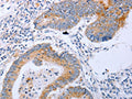 The image on the left is immunohistochemistry of paraffin-embedded Human colon cancer tissue using CSB-PA189054(DNMT3L Antibody) at dilution 1/10, on the right is treated with fusion protein. (Original magnification: ×200)