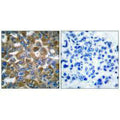Immunohistochemical analysis of paraffin-embedded human breast carcinoma tissue using Keratin 15 antibody.