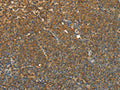 The image on the left is immunohistochemistry of paraffin-embedded Human lymphoma tissue using CSB-PA190435(TEKT1 Antibody) at dilution 1/30, on the right is treated with fusion protein. (Original magnification: ×200)