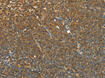 The image on the left is immunohistochemistry of paraffin-embedded Human lymphoma tissue using CSB-PA190435(TEKT1 Antibody) at dilution 1/30, on the right is treated with fusion protein. (Original magnification: ×200)