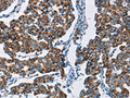 The image on the left is immunohistochemistry of paraffin-embedded Human breast cancer tissue using CSB-PA190666(HINT2 Antibody) at dilution 1/50, on the right is treated with fusion protein. (Original magnification: ×200)