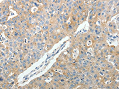 The image on the left is immunohistochemistry of paraffin-embedded Human ovarian cancer tissue using CSB-PA191275(PTGDS Antibody) at dilution 1/10, on the right is treated with fusion protein. (Original magnification: ×200)