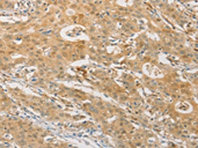 The image on the left is immunohistochemistry of paraffin-embedded Human gastic cancer tissue using CSB-PA191316(PGK2 Antibody) at dilution 1/50, on the right is treated with fusion protein. (Original magnification: ×200)