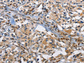 The image on the left is immunohistochemistry of paraffin-embedded Human thyroid cancer tissue using CSB-PA191502(FOS Antibody) at dilution 1/70, on the right is treated with fusion protein. (Original magnification: ×200)