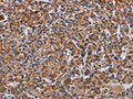The image on the left is immunohistochemistry of paraffin-embedded Human prostate cancer tissue using CSB-PA191838(LRRC15 Antibody) at dilution 1/60, on the right is treated with fusion protein. (Original magnification: ×200)