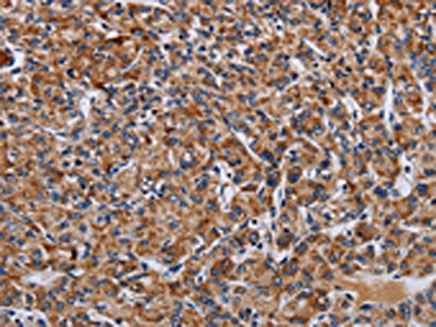 The image on the left is immunohistochemistry of paraffin-embedded Human prostate cancer tissue using CSB-PA191838(LRRC15 Antibody) at dilution 1/60, on the right is treated with fusion protein. (Original magnification: ×200)