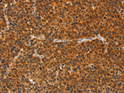 The image on the left is immunohistochemistry of paraffin-embedded Human liver cancer tissue using CSB-PA192244(IKZF3 Antibody) at dilution 1/60, on the right is treated with fusion protein. (Original magnification: ×200)