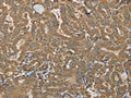 The image on the left is immunohistochemistry of paraffin-embedded Human thyroid cancer tissue using CSB-PA192307(SDHB Antibody) at dilution 1/30, on the right is treated with synthetic peptide. (Original magnification: ×200)