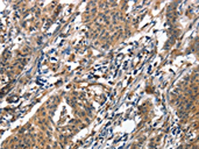 The image on the left is immunohistochemistry of paraffin-embedded Human gastic cancer tissue using CSB-PA192309(ALOX15 Antibody) at dilution 1/50, on the right is treated with synthetic peptide. (Original magnification: ×200)