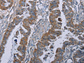 The image on the left is immunohistochemistry of paraffin-embedded Human esophagus cancer tissue using CSB-PA192641(BMP3 Antibody) at dilution 1/30, on the right is treated with synthetic peptide. (Original magnification: ×200)
