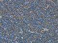 The image on the left is immunohistochemistry of paraffin-embedded Human lymphoma tissue using CSB-PA192719(COX7B2 Antibody) at dilution 1/15, on the right is treated with fusion protein. (Original magnification: ×200)