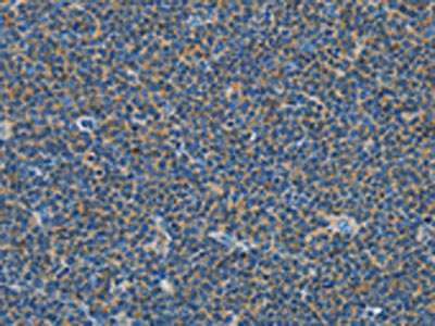 The image on the left is immunohistochemistry of paraffin-embedded Human lymphoma tissue using CSB-PA192719(COX7B2 Antibody) at dilution 1/15, on the right is treated with fusion protein. (Original magnification: ×200)
