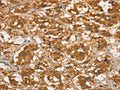 The image on the left is immunohistochemistry of paraffin-embedded Human thyroid cancer tissue using CSB-PA192852(RBBP8 Antibody) at dilution 1/45, on the right is treated with fusion protein. (Original magnification: ×200)