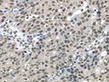 The image on the left is immunohistochemistry of paraffin-embedded Human breast cancer tissue using CSB-PA192926(HDAC1 Antibody) at dilution 1/20, on the right is treated with fusion protein. (Original magnification: ×200)