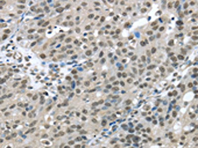 The image on the left is immunohistochemistry of paraffin-embedded Human breast cancer tissue using CSB-PA192926(HDAC1 Antibody) at dilution 1/20, on the right is treated with fusion protein. (Original magnification: ×200)
