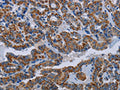 The image on the left is immunohistochemistry of paraffin-embedded Human thyroid cancer tissue using CSB-PA193298(NDUFS8 Antibody) at dilution 1/20, on the right is treated with fusion protein. (Original magnification: ×200)