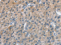 The image on the left is immunohistochemistry of paraffin-embedded Human liver cancer tissue using CSB-PA193346(TRIP4 Antibody) at dilution 1/50, on the right is treated with fusion protein. (Original magnification: ×200)