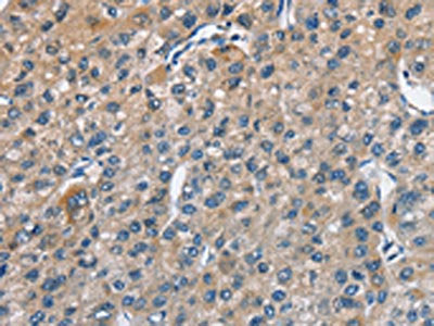 The image on the left is immunohistochemistry of paraffin-embedded Human liver cancer tissue using CSB-PA193346(TRIP4 Antibody) at dilution 1/50, on the right is treated with fusion protein. (Original magnification: ×200)