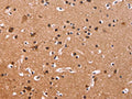 The image on the left is immunohistochemistry of paraffin-embedded Human brain tissue using CSB-PA193371(CSNK1D Antibody) at dilution 1/50, on the right is treated with fusion protein. (Original magnification: ×200)