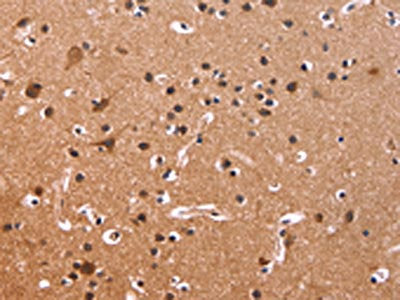 The image on the left is immunohistochemistry of paraffin-embedded Human brain tissue using CSB-PA193371(CSNK1D Antibody) at dilution 1/50, on the right is treated with fusion protein. (Original magnification: ×200)