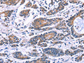 The image on the left is immunohistochemistry of paraffin-embedded Human colon cancer tissue using CSB-PA193423(SYT4 Antibody) at dilution 1/60, on the right is treated with fusion protein. (Original magnification: ×200)