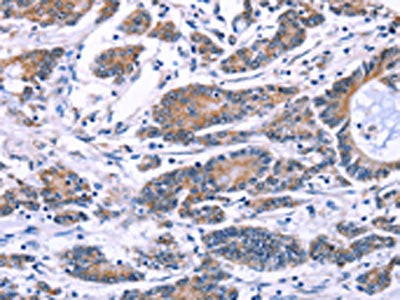 The image on the left is immunohistochemistry of paraffin-embedded Human colon cancer tissue using CSB-PA193423(SYT4 Antibody) at dilution 1/60, on the right is treated with fusion protein. (Original magnification: ×200)