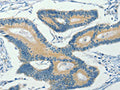 The image on the left is immunohistochemistry of paraffin-embedded Human colon cancer tissue using CSB-PA193476(ASB8 Antibody) at dilution 1/30, on the right is treated with fusion protein. (Original magnification: ×200)