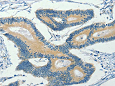 The image on the left is immunohistochemistry of paraffin-embedded Human colon cancer tissue using CSB-PA193476(ASB8 Antibody) at dilution 1/30, on the right is treated with fusion protein. (Original magnification: ×200)