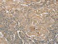 The image on the left is immunohistochemistry of paraffin-embedded Human cervical cancer tissue using CSB-PA193486(PIK3CD Antibody) at dilution 1/35, on the right is treated with synthetic peptide. (Original magnification: ×200)