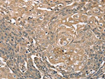 The image on the left is immunohistochemistry of paraffin-embedded Human cervical cancer tissue using CSB-PA193486(PIK3CD Antibody) at dilution 1/35, on the right is treated with synthetic peptide. (Original magnification: ×200)