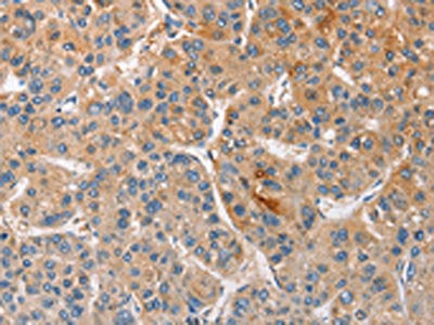 The image on the left is immunohistochemistry of paraffin-embedded Human liver cancer tissue using CSB-PA193639(CCL4 Antibody) at dilution 1/40, on the right is treated with fusion protein. (Original magnification: ×200)
