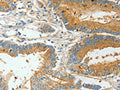 The image on the left is immunohistochemistry of paraffin-embedded Human colon cancer tissue using CSB-PA194965(BAAT Antibody) at dilution 1/30, on the right is treated with fusion protein. (Original magnification: ×200)