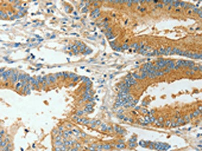 The image on the left is immunohistochemistry of paraffin-embedded Human colon cancer tissue using CSB-PA194965(BAAT Antibody) at dilution 1/30, on the right is treated with fusion protein. (Original magnification: ×200)