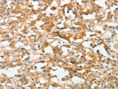 The image on the left is immunohistochemistry of paraffin-embedded Human thyroid cancer tissue using CSB-PA195221(UCHL5 Antibody) at dilution 1/20, on the right is treated with fusion protein. (Original magnification: ×200)