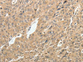 The image on the left is immunohistochemistry of paraffin-embedded Human ovarian cancer tissue using CSB-PA195276(TH Antibody) at dilution 1/10, on the right is treated with synthetic peptide. (Original magnification: ×200)