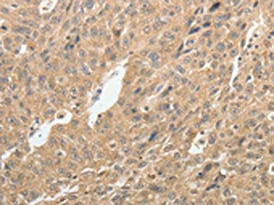 The image on the left is immunohistochemistry of paraffin-embedded Human ovarian cancer tissue using CSB-PA195276(TH Antibody) at dilution 1/10, on the right is treated with synthetic peptide. (Original magnification: ×200)