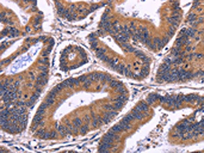 The image on the left is immunohistochemistry of paraffin-embedded Human colon cancer tissue using CSB-PA195430(SPATA7 Antibody) at dilution 1/30, on the right is treated with fusion protein. (Original magnification: ×200)