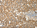 The image on the left is immunohistochemistry of paraffin-embedded Human breast cancer tissue using CSB-PA195573(PRDX3 Antibody) at dilution 1/50, on the right is treated with fusion protein. (Original magnification: ×200)