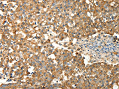 The image on the left is immunohistochemistry of paraffin-embedded Human breast cancer tissue using CSB-PA195573(PRDX3 Antibody) at dilution 1/50, on the right is treated with fusion protein. (Original magnification: ×200)