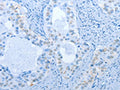 The image on the left is immunohistochemistry of paraffin-embedded Human cervical cancer tissue using CSB-PA195686(NAE1 Antibody) at dilution 1/20, on the right is treated with fusion protein. (Original magnification: ×200)