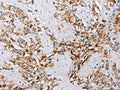The image on the left is immunohistochemistry of paraffin-embedded Human prostate cancer tissue using CSB-PA195861(ATG4C Antibody) at dilution 1/25, on the right is treated with fusion protein. (Original magnification: ×200)