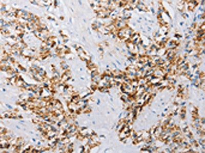 The image on the left is immunohistochemistry of paraffin-embedded Human prostate cancer tissue using CSB-PA195861(ATG4C Antibody) at dilution 1/25, on the right is treated with fusion protein. (Original magnification: ×200)