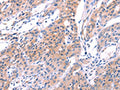 The image on the left is immunohistochemistry of paraffin-embedded Human lung cancer tissue using CSB-PA195869(VWF Antibody) at dilution 1/50, on the right is treated with fusion protein. (Original magnification: ×200)
